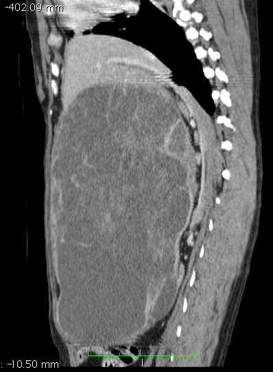 reconstructed ct showing spleen